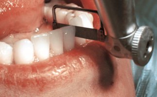 IPR Zahnschmelzreduktion